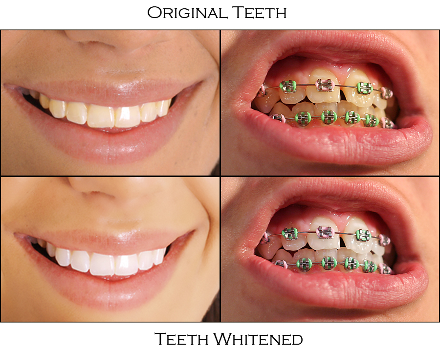 strawberry teeth whitening before and after